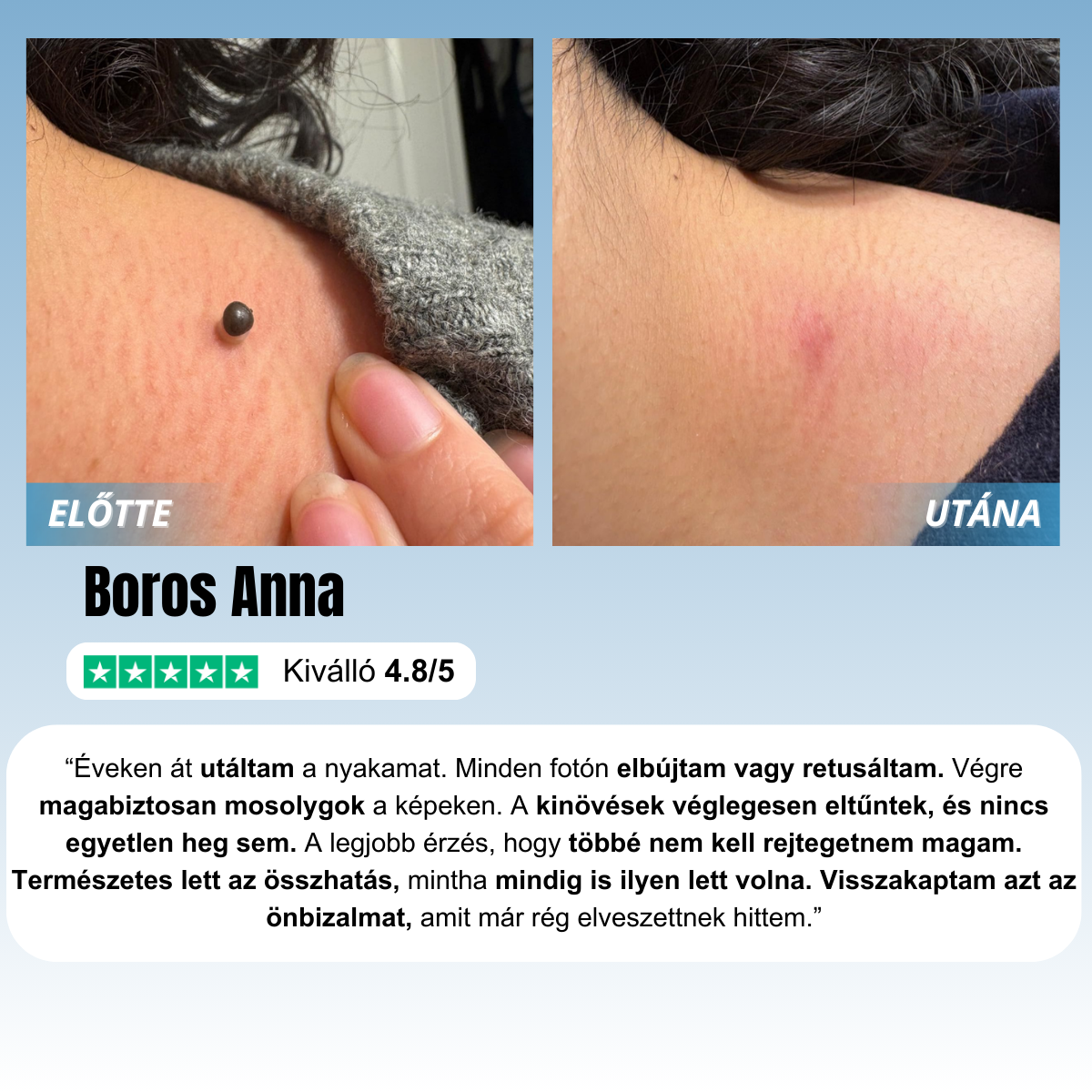Otthoni Bőrkinövés Eltávolító Készlet