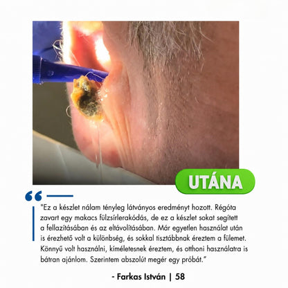 Elektromos Fülzsír Eltávolító Készlet